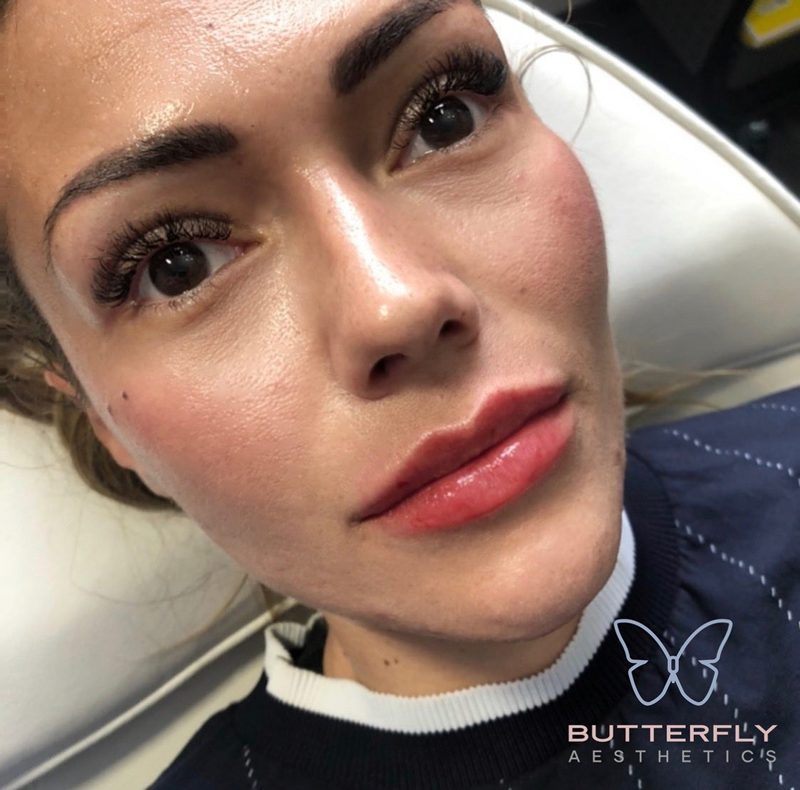 Cheek Enhancement: An Effective Way To Improve Facial Contours