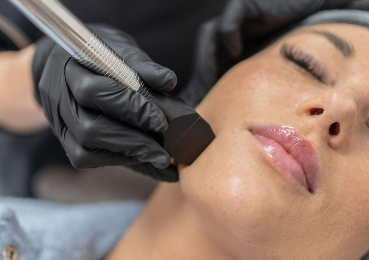 Can jowls be lifted without surgery?