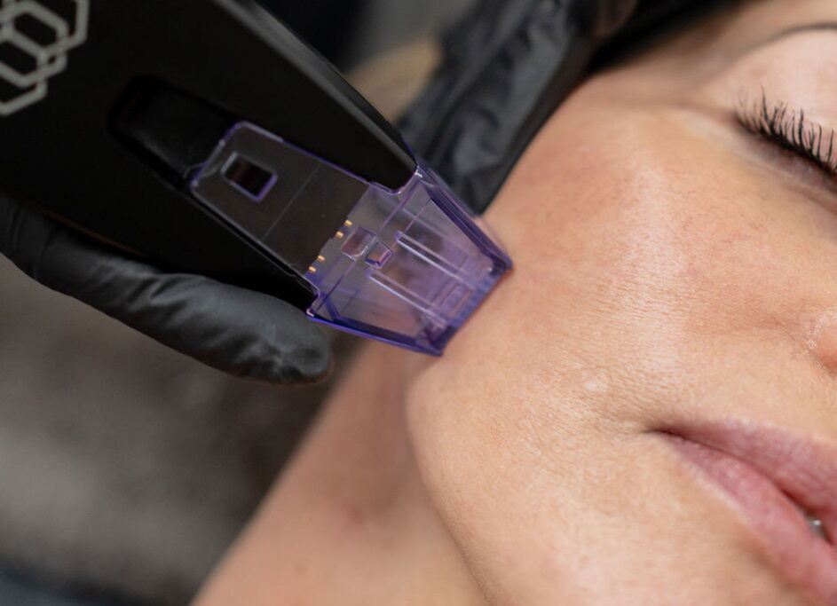 Morpheus8: What does it do? And when will I see results?