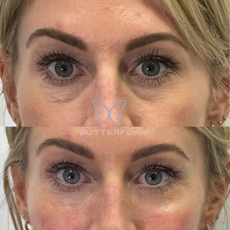 Tear Trough Treatment: How To Improve Dark Circles And Hollows