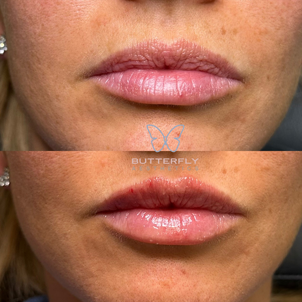Lip Fillers Before & After