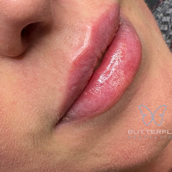Lip Fillers