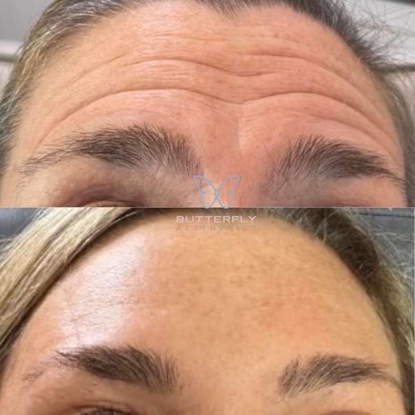 Dive Into The Butterfly Effect With The Best Lines And Wrinkle Treatments