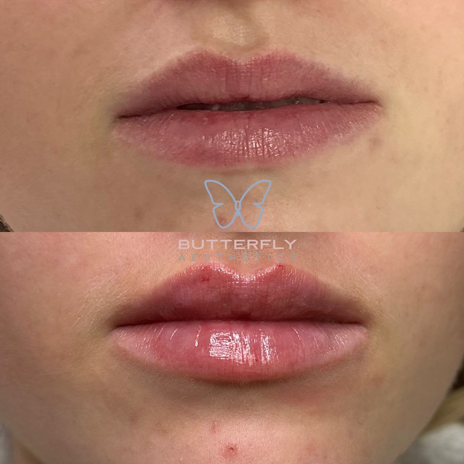 Do Lip Fillers Hurt? What a Lip Enhancement Really Feels Like