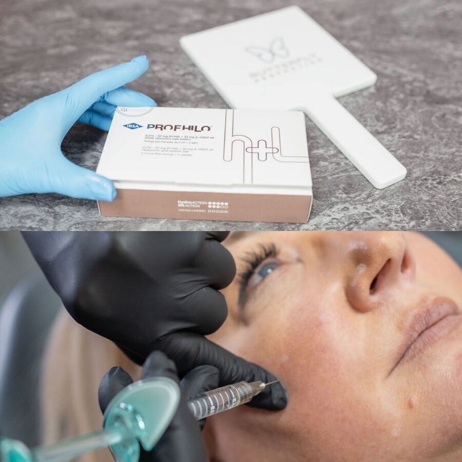 Profhilo or dermal fillers?
