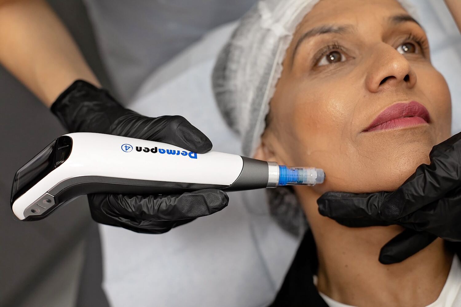 What is Microneedling? How does it work? And will it get rid of wrinkles?
