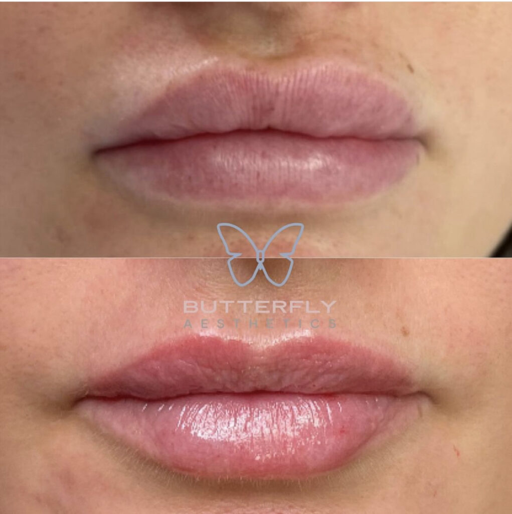 Lip Dissolving and Correction Treatment Before And After