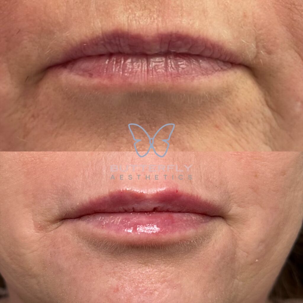 Lip Lines Treatment Wakefield West Yorkshire