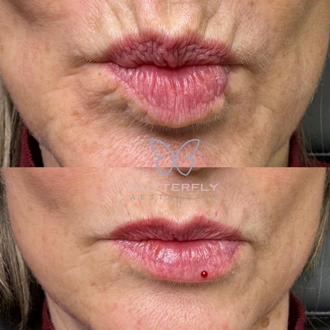 Anti Wrinkle Injections Butterfly Aesthetics Wakefield
