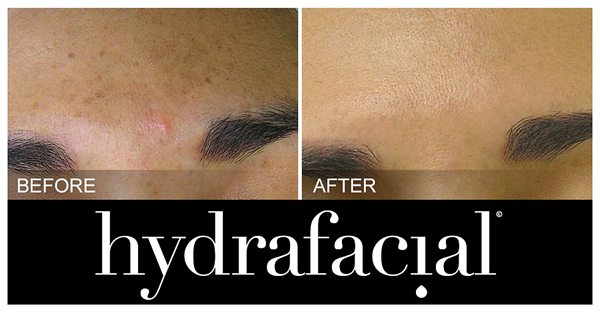Hydrafacial Before And After