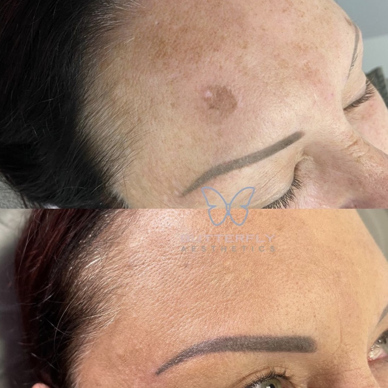 Pigmentation Before And After Butterfly Aesthetics Wakefield