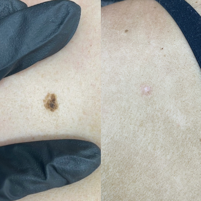 Skin Tags Mole Removal Butterfly Aesthetics Wakefield 2
